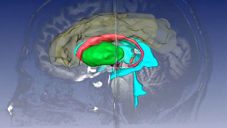 3D-Darstellung des Gehirns mit farblich markierten Bereichen.